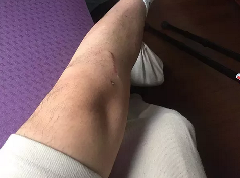 股四头肌有雏形了
