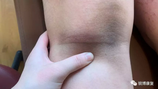 腘窝偏外侧的挤着疼